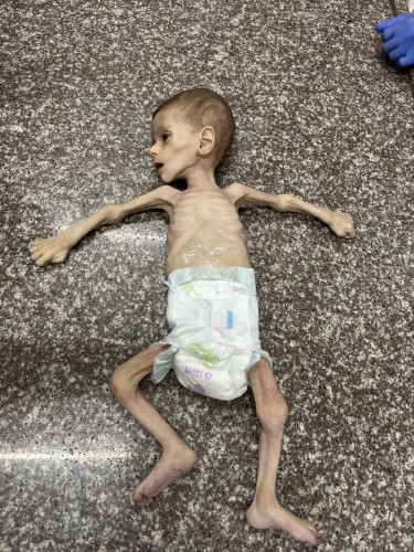 extremely disturbing image of a palestinian child who died as the result of severe mallnurishment.
